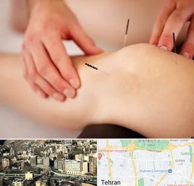 دکتر طب سوزنی برای لاغری در مرزداران 