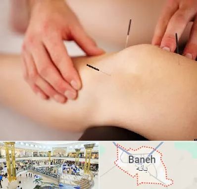 دکتر طب سوزنی برای لاغری در بانه