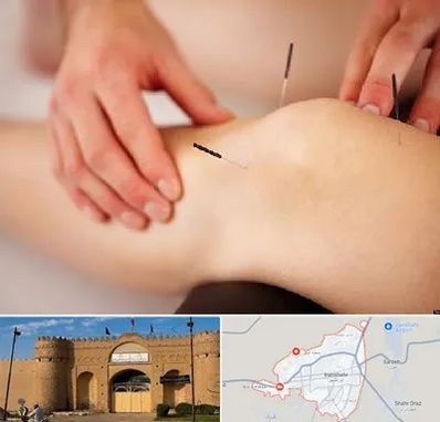 دکتر طب سوزنی برای لاغری در ایرانشهر