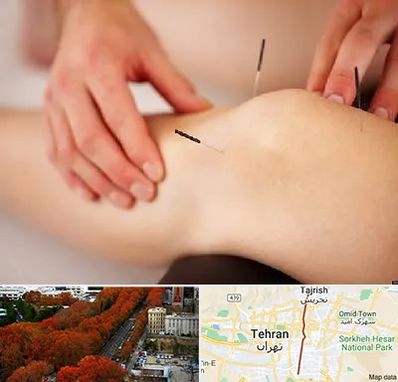 دکتر طب سوزنی برای لاغری در ولیعصر 