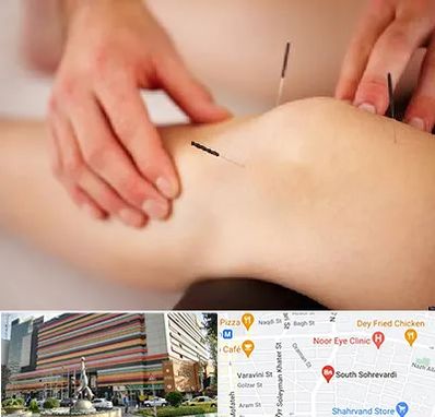 دکتر طب سوزنی برای لاغری در سهروردی 