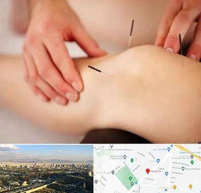 دکتر طب سوزنی برای لاغری در هنگام 