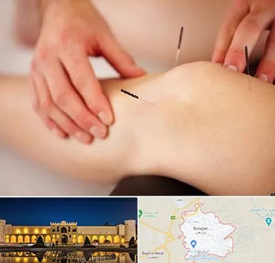 دکتر طب سوزنی برای لاغری در برازجان