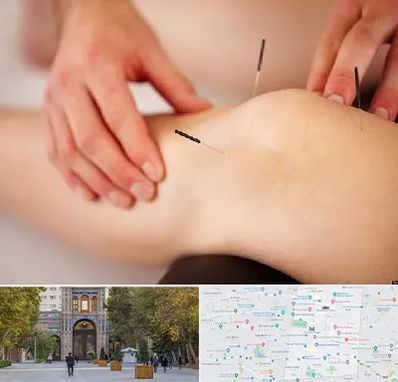 دکتر طب سوزنی برای لاغری در منطقه 12 تهران 