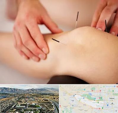 دکتر طب سوزنی برای لاغری در منطقه 21 تهران 