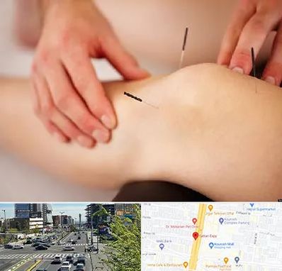 دکتر طب سوزنی برای لاغری در ستاری 