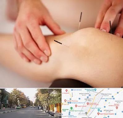 دکتر طب سوزنی برای لاغری در شریعتی 