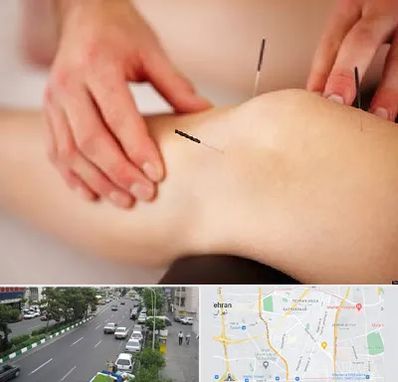 دکتر طب سوزنی برای لاغری در ستارخان 