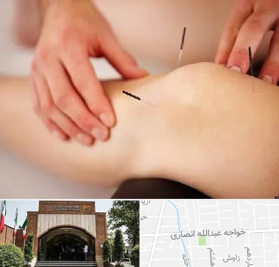 دکتر طب سوزنی برای لاغری در خواجه عبدالله