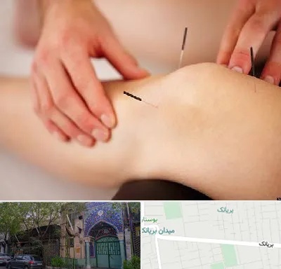 دکتر طب سوزنی برای لاغری در بریانک