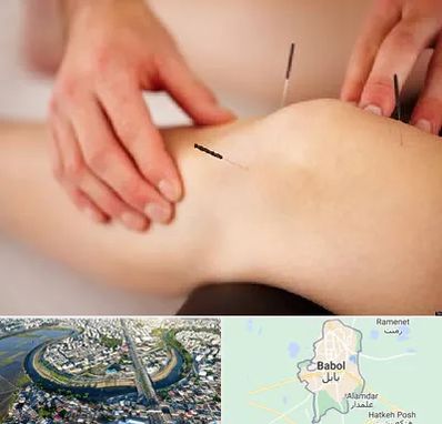 دکتر طب سوزنی برای لاغری در بابل