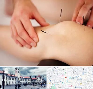 دکتر طب سوزنی برای لاغری در میدان شهرداری رشت 