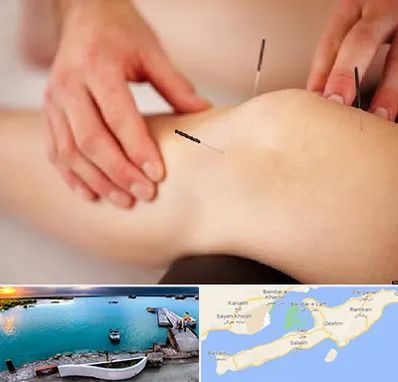 دکتر طب سوزنی برای لاغری در قشم