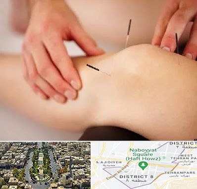 دکتر طب سوزنی برای لاغری در نارمک 