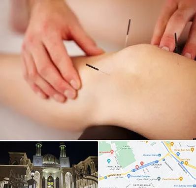 دکتر طب سوزنی برای لاغری در زرگری شیراز 