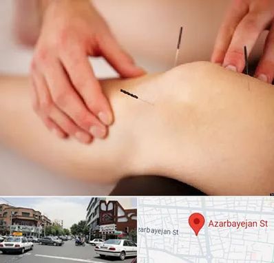 دکتر طب سوزنی برای لاغری در خیابان آذربایجان