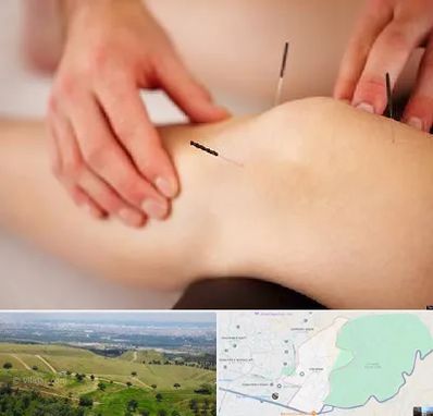 دکتر طب سوزنی برای لاغری در سوهانک