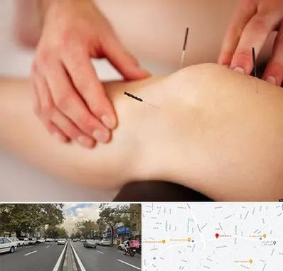 دکتر طب سوزنی برای لاغری در دولت 