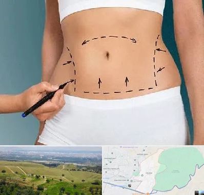 دکتر طب سنتی برای لاغری در سوهانک