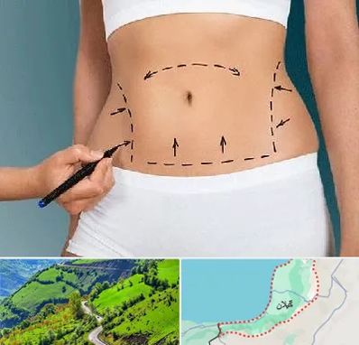 دکتر طب سنتی برای لاغری در گیلان