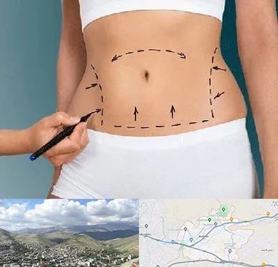 دکتر طب سنتی برای لاغری در رودهن