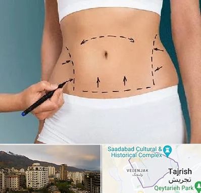 دکتر طب سنتی برای لاغری در زعفرانیه 