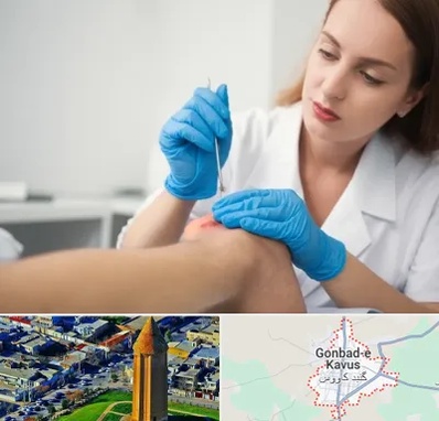 متخصص زخم در گنبد کاووس