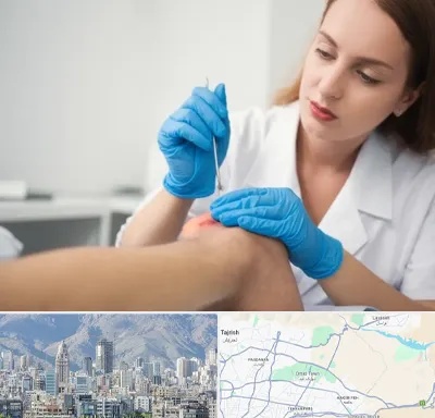 متخصص زخم در شمال شرق تهران