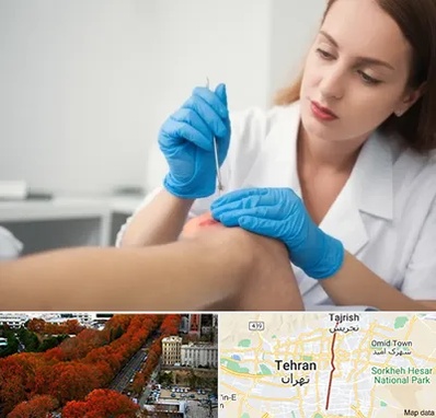 متخصص زخم در ولیعصر 