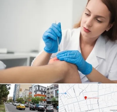 متخصص زخم در هفده شهریور تبریز 