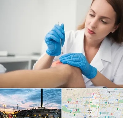 متخصص زخم در منطقه 2 تهران 