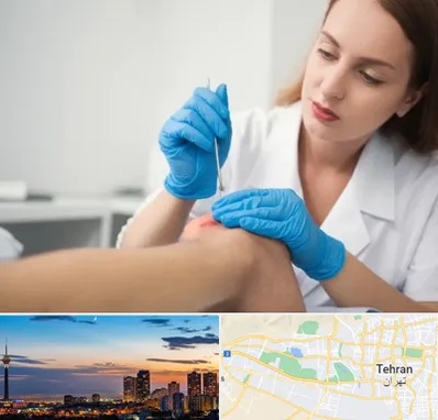 متخصص زخم در غرب تهران 