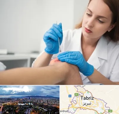 متخصص زخم در تبریز