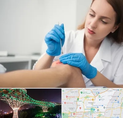 متخصص زخم در منطقه 3 تهران 