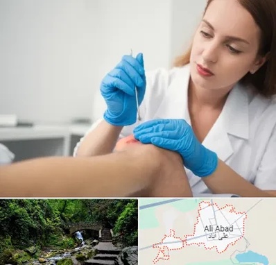 متخصص زخم در علی‌ آباد کتول