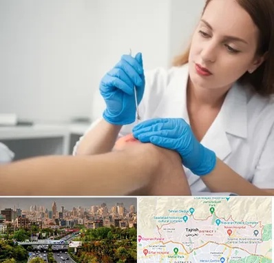 متخصص زخم در منطقه 1 تهران 