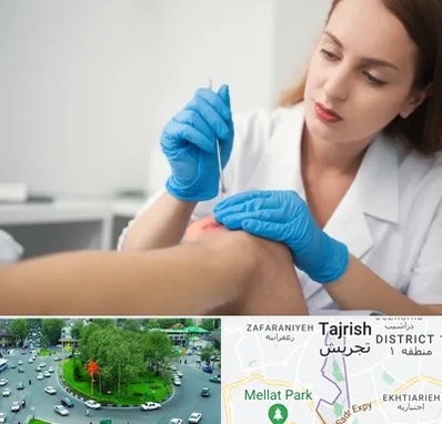 متخصص زخم در تجریش 