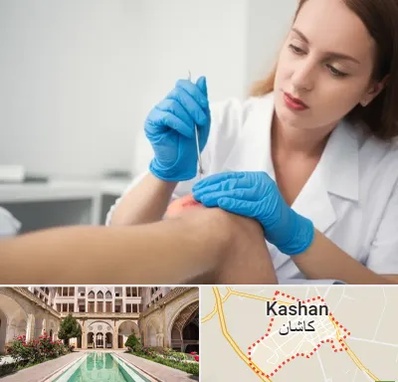 متخصص زخم در کاشان
