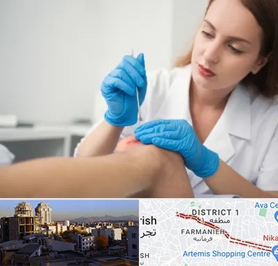 متخصص زخم در فرمانیه 