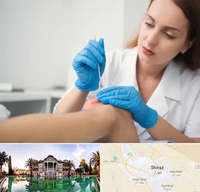 متخصص زخم در شیراز