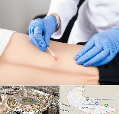 متخصص زخم بستر در پرند