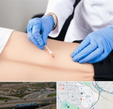 متخصص زخم بستر در یاغچیان تبریز 