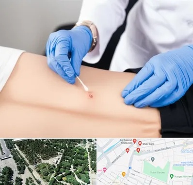 متخصص زخم بستر در سالاریه قم 