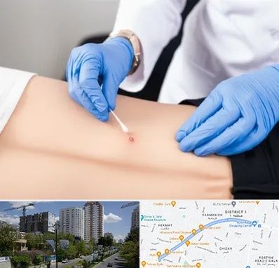 متخصص زخم بستر در اندرزگو 