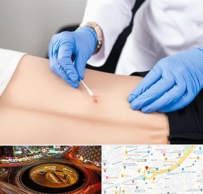 متخصص زخم بستر در میدان ولیعصر