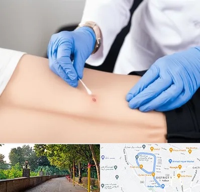 متخصص زخم بستر در فلکه گاز رشت 