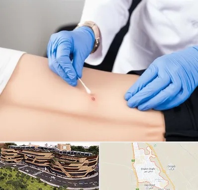 متخصص زخم بستر در شاهین شهر