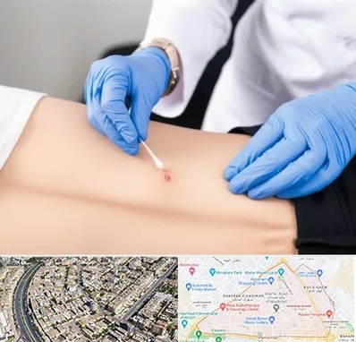 متخصص زخم بستر در شهرک غرب مشهد 