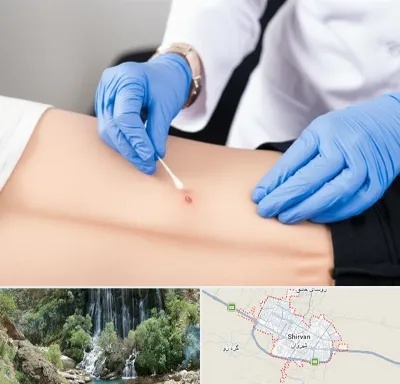 متخصص زخم بستر در شیروان