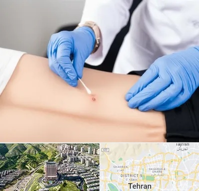 متخصص زخم بستر در شمال تهران 